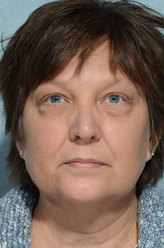 Eyelid (Blepharoplasty)