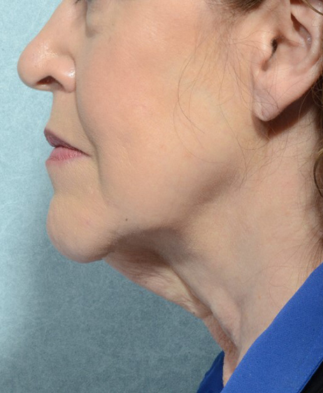 Facelift