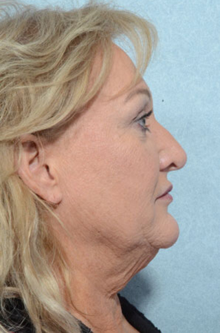 Facelift